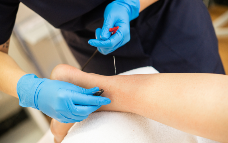 Jordan Sudberg Explains the Needles: Acupuncture vs. Dry Needling—What Works and Why