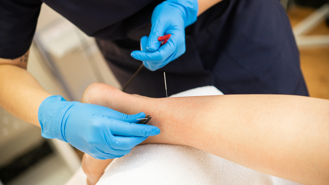 Jordan Sudberg Explains the Needles: Acupuncture vs. Dry Needling—What Works and Why